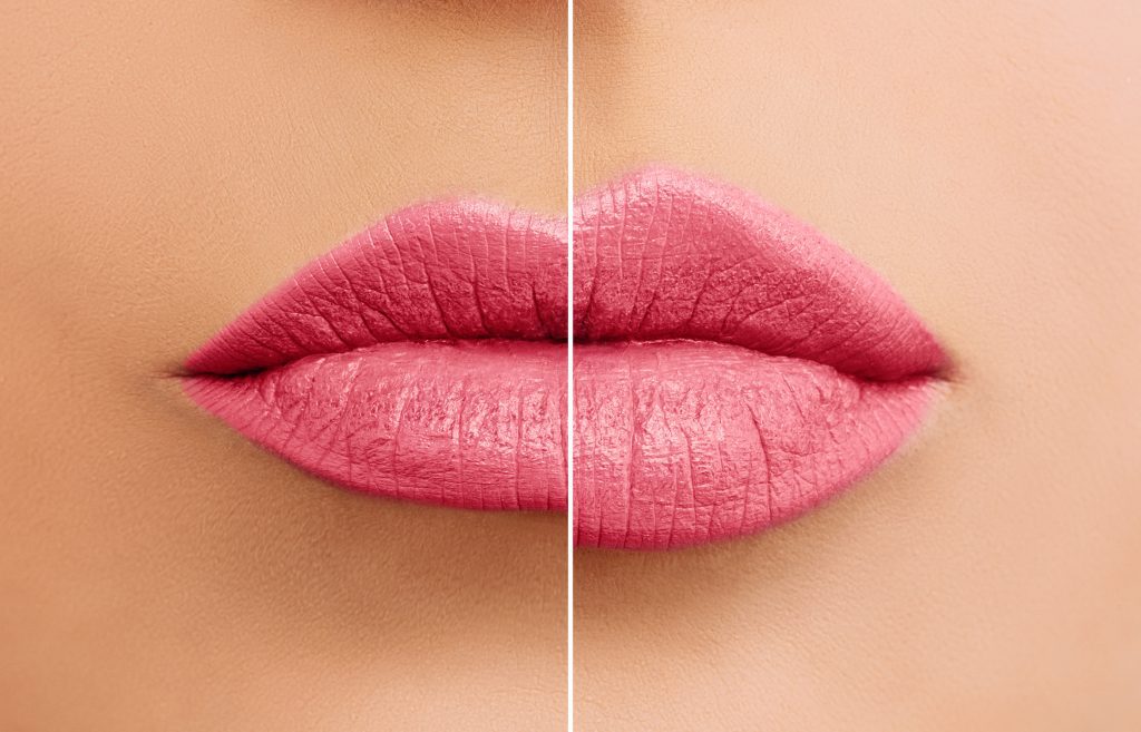 Lips before and after having lip filler 