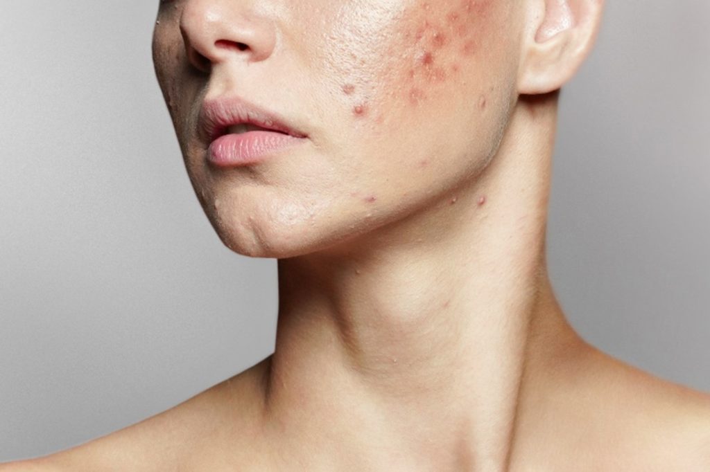 Woman's lower face with acne