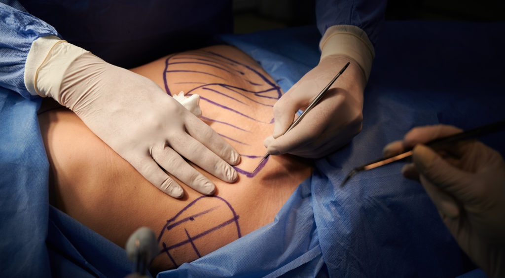 Someone undergoing tummy tuck surgery