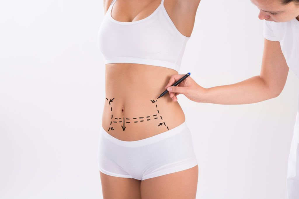 Tummy tuck surgery at Aesthetic Skin Clinic