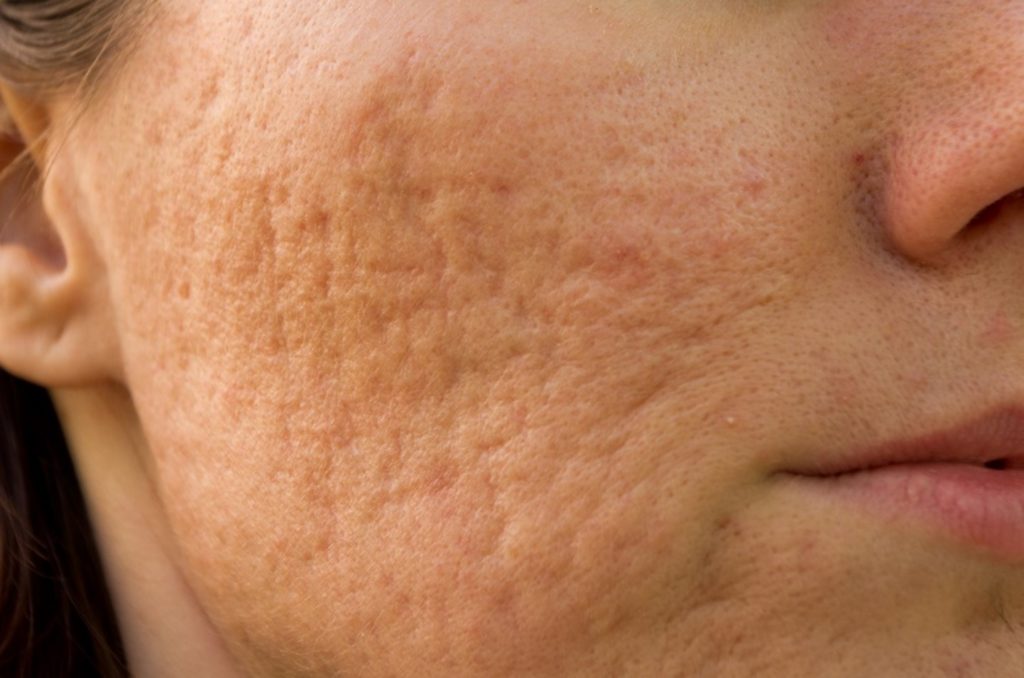 Woman's cheek with enlarged pores