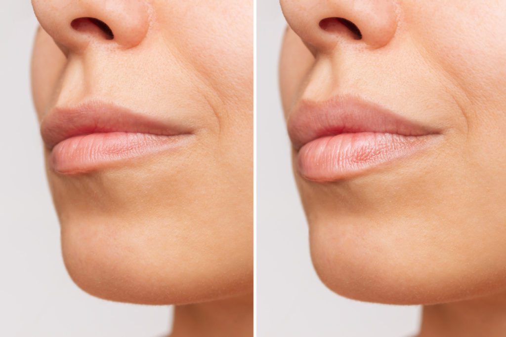 Before and after of lip fillers at Aesthetic Skin Clinic