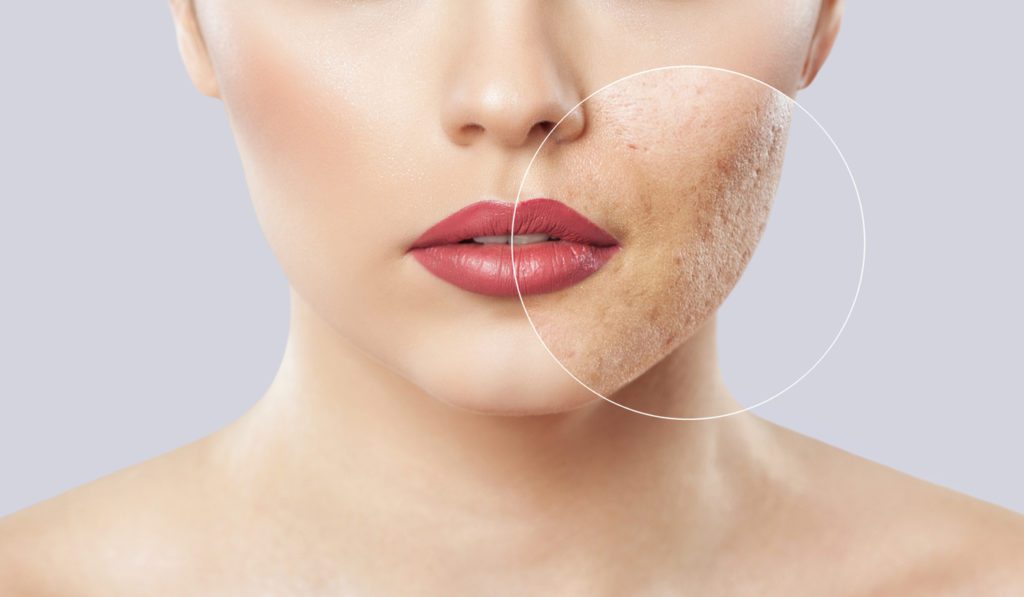 An in-depth look into acne scarring