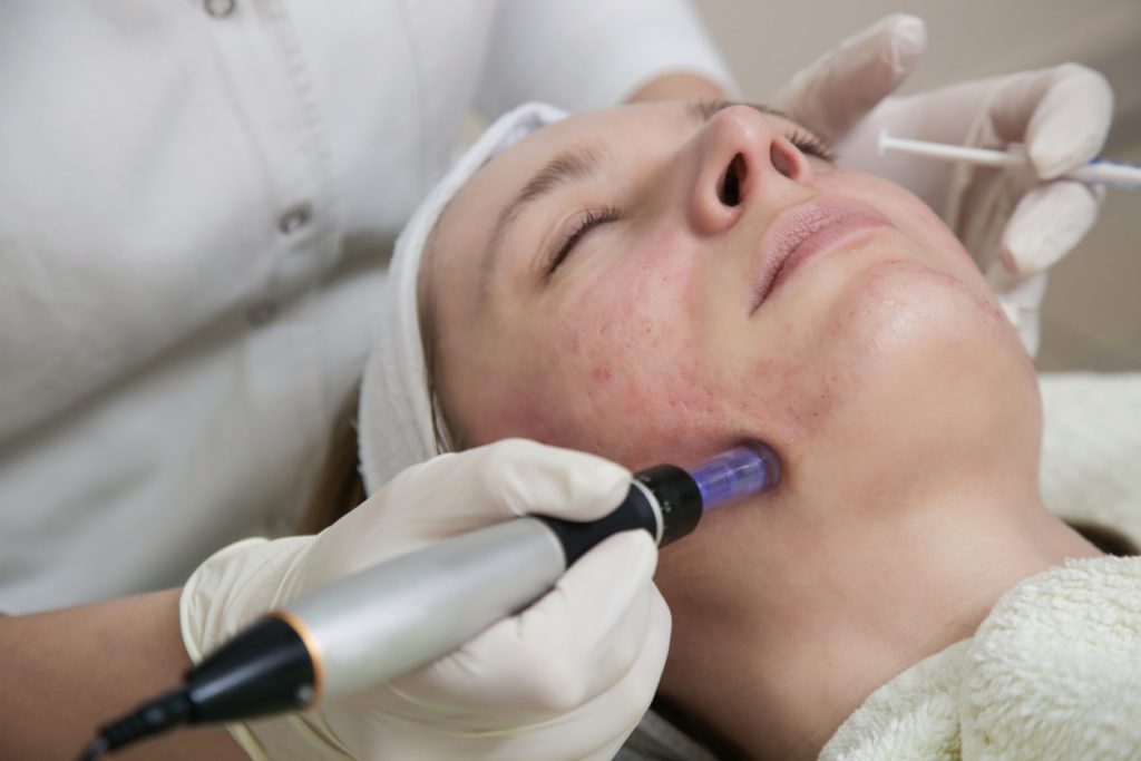 Someone going through Intracel Radiofrequency Microneedling treatment 