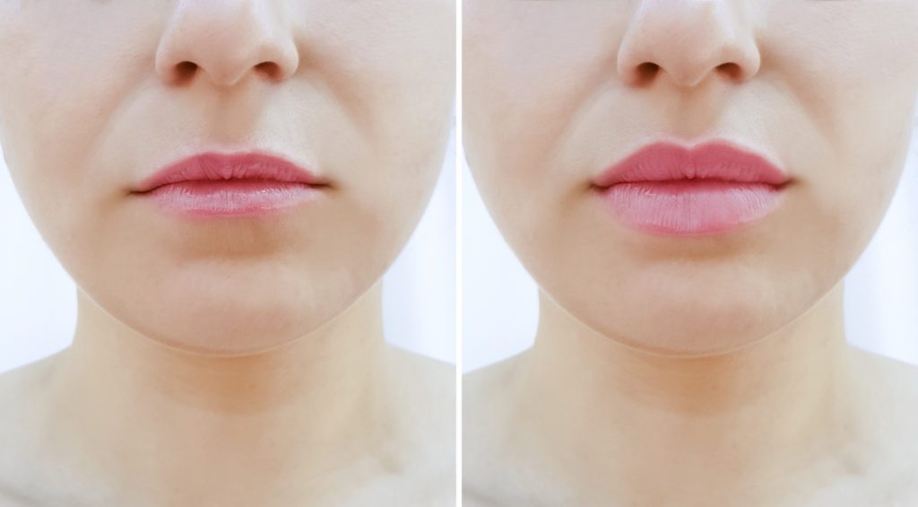 Before and after lip fillers