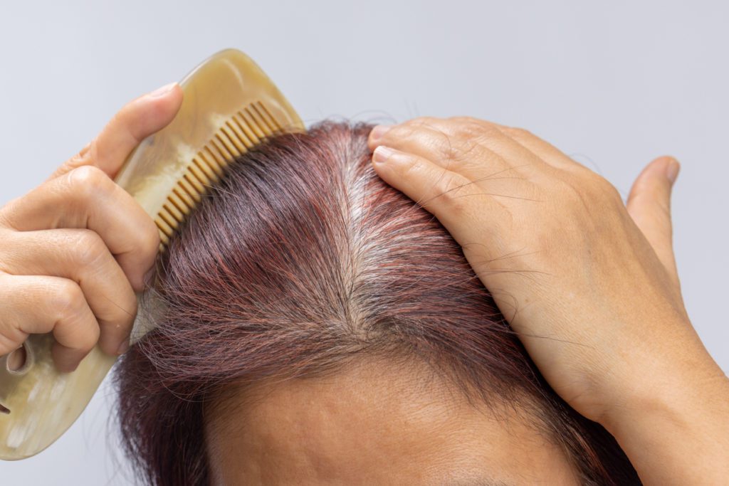 Woman losing hair due to menopause