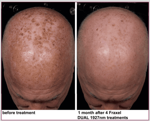 Before and after Fraxel on a man's bald head