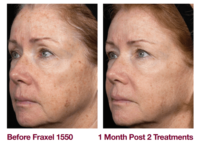 Before and after Fraxel on a woman's face