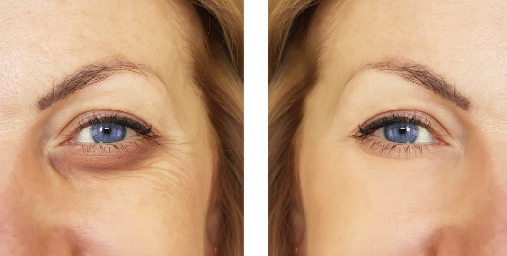 Woman's eye bags before and after surgery