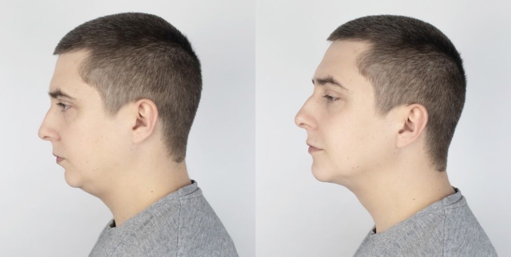 before and after jaw surgery